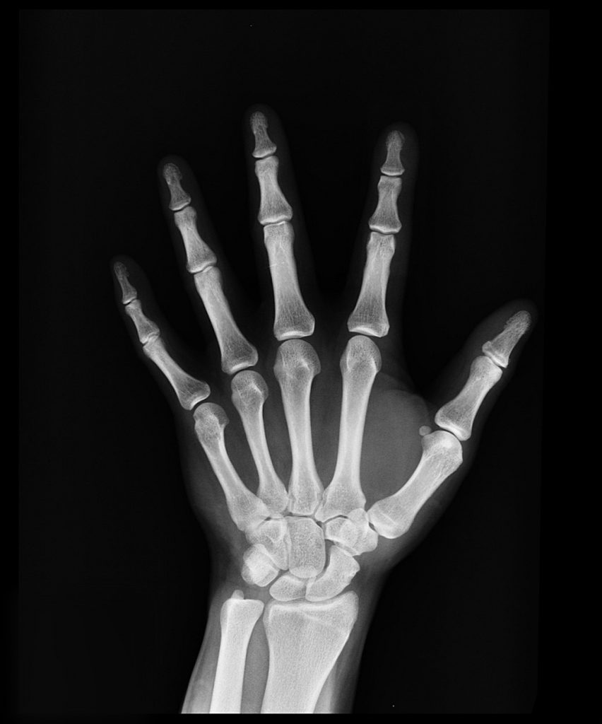 My X-Ray Says I Have What? Words Matter.