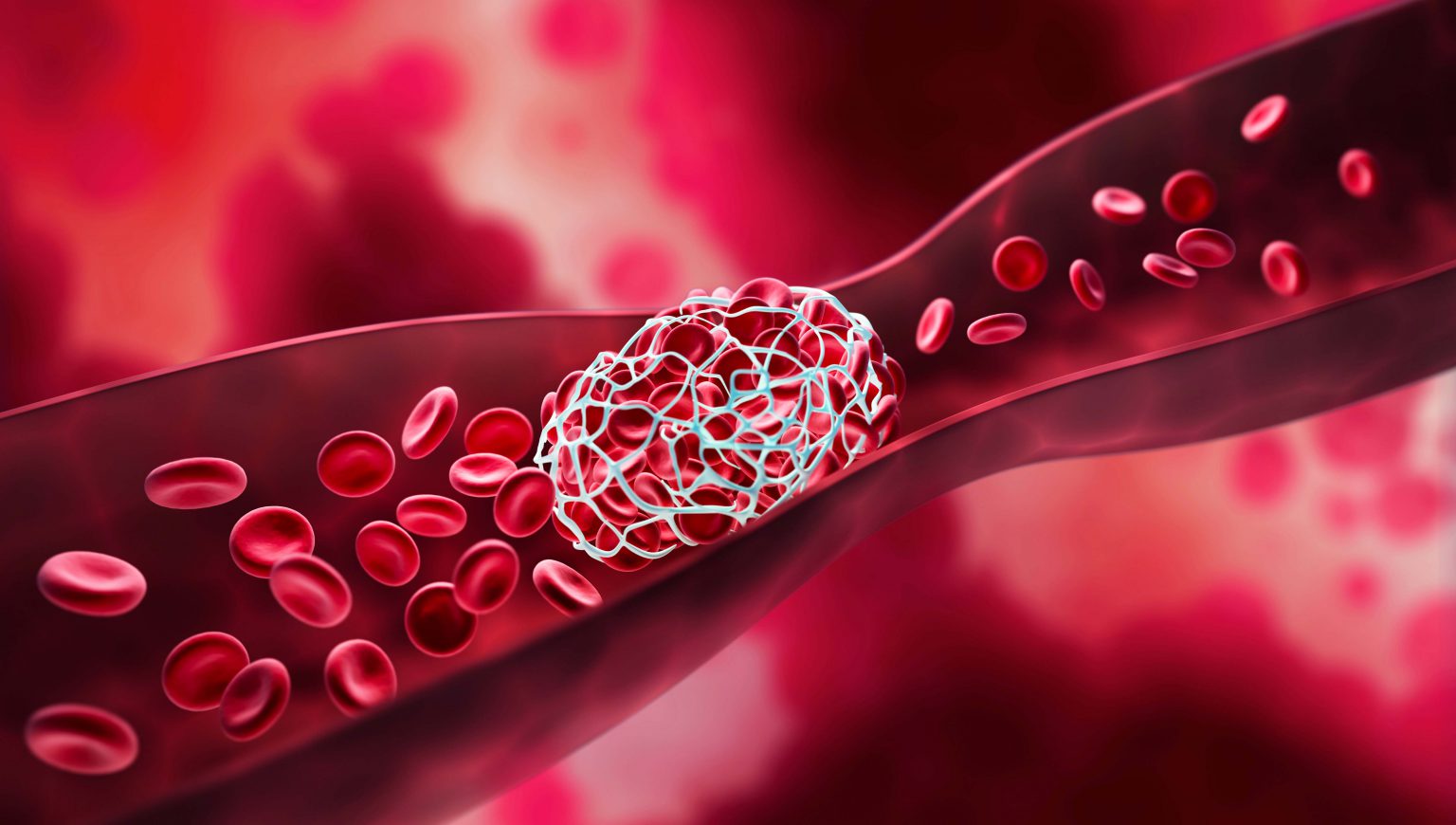 How Physical Therapy Can Help with Blood Clots Fabrication Enterprises